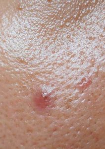 KUlit wajah berminyak