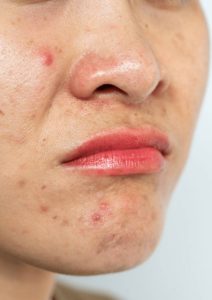 Kemunculan bintik atau jerawat kecil